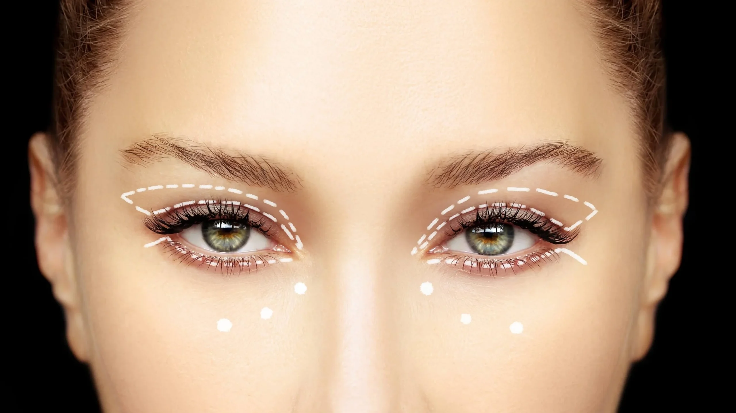 Blepharoplasty in Dubai
